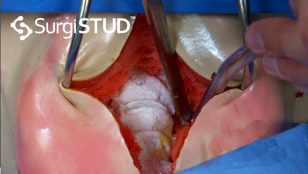 Anterior cervical discectomy and fusion