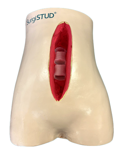 Unleashing Surgical Potential: A Custom STUD for ALIF Technique Advancement