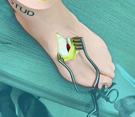 Saving Time and Money with Synthetic Bunion Surgical Model