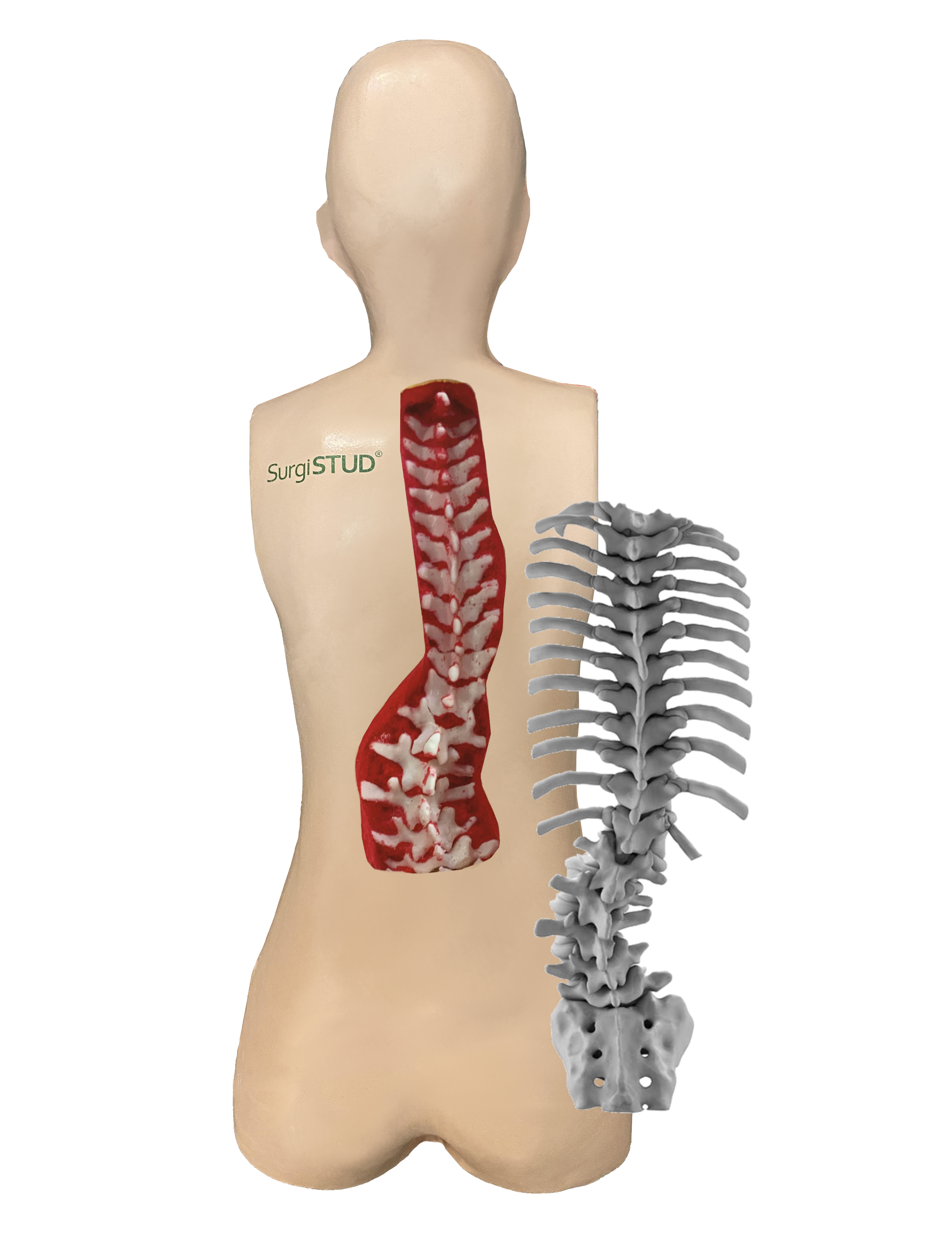 Adult Degenerative Scoliosis
