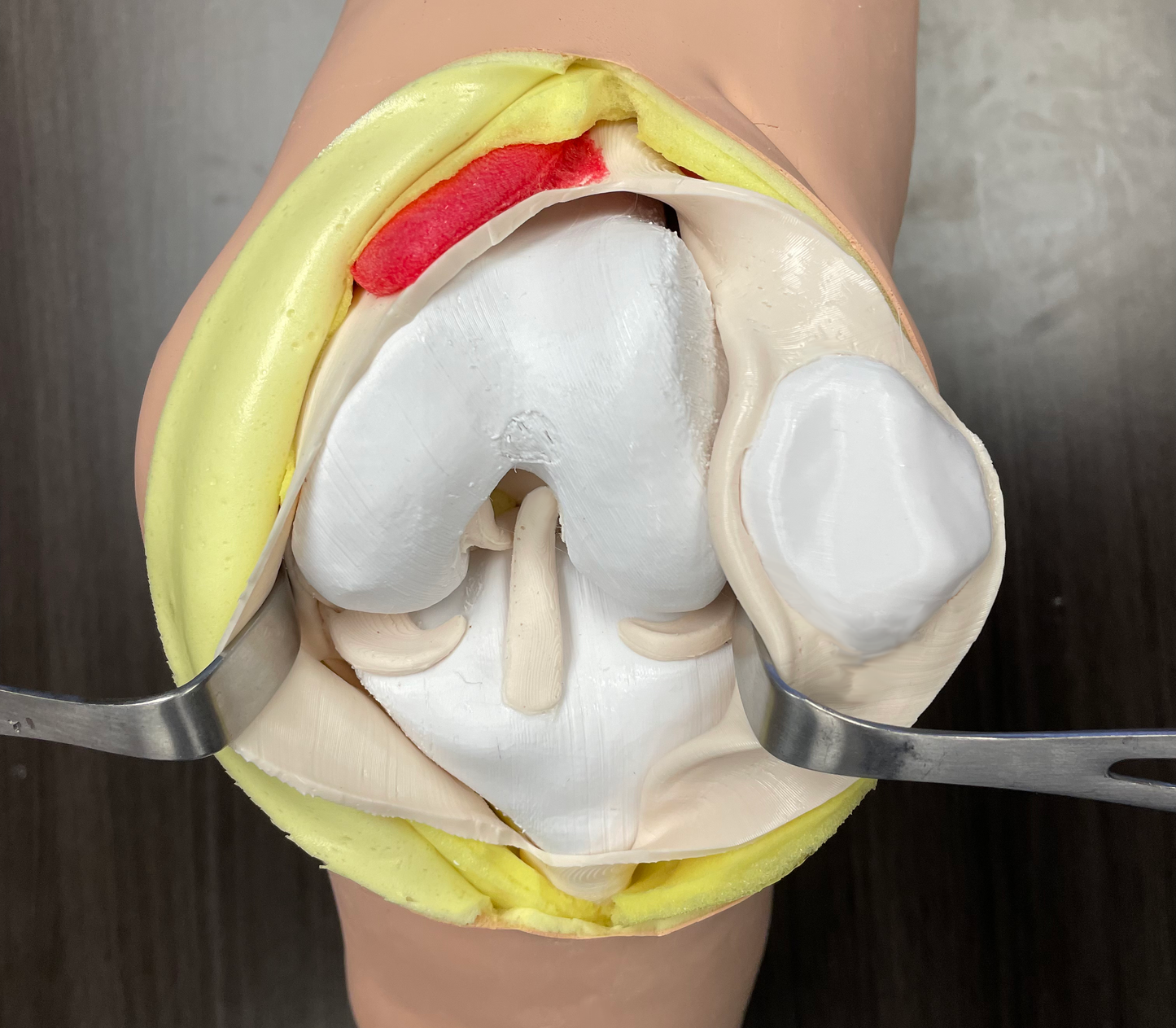 Comprehensive Knee – Casted