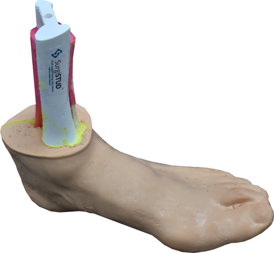 Comprehensive Bunion Foot – Cast