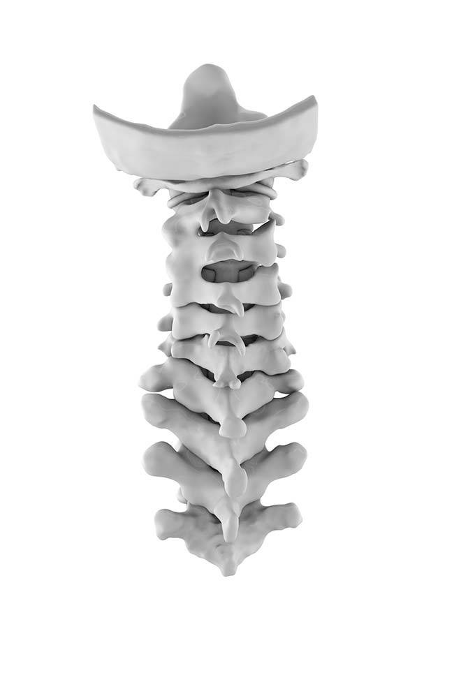 Chin-On-Chest Deformity 1