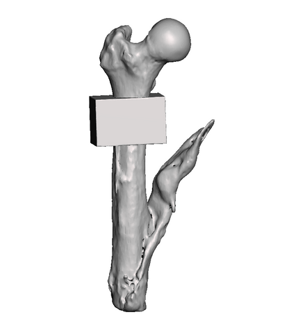 Mid Femur Amputee 1