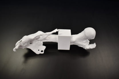 Mid Femur Amputee 2