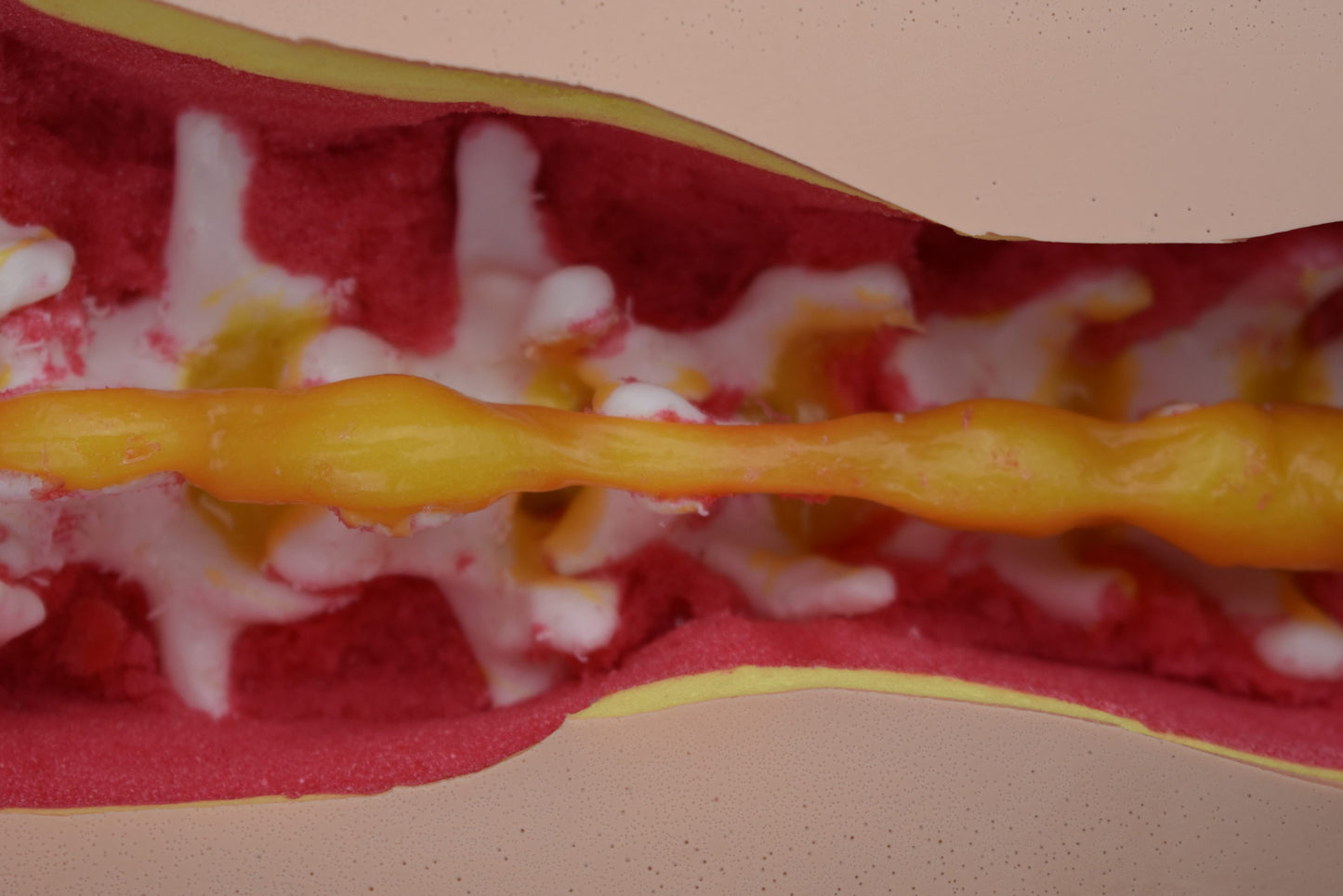 Occiput to Sacrum Trauma Spine