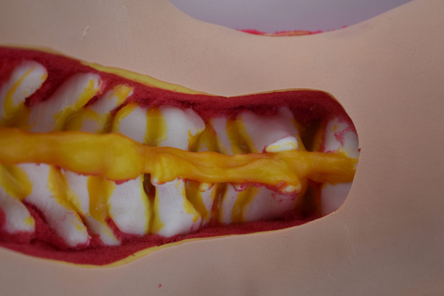 Occiput to Sacrum Trauma Spine