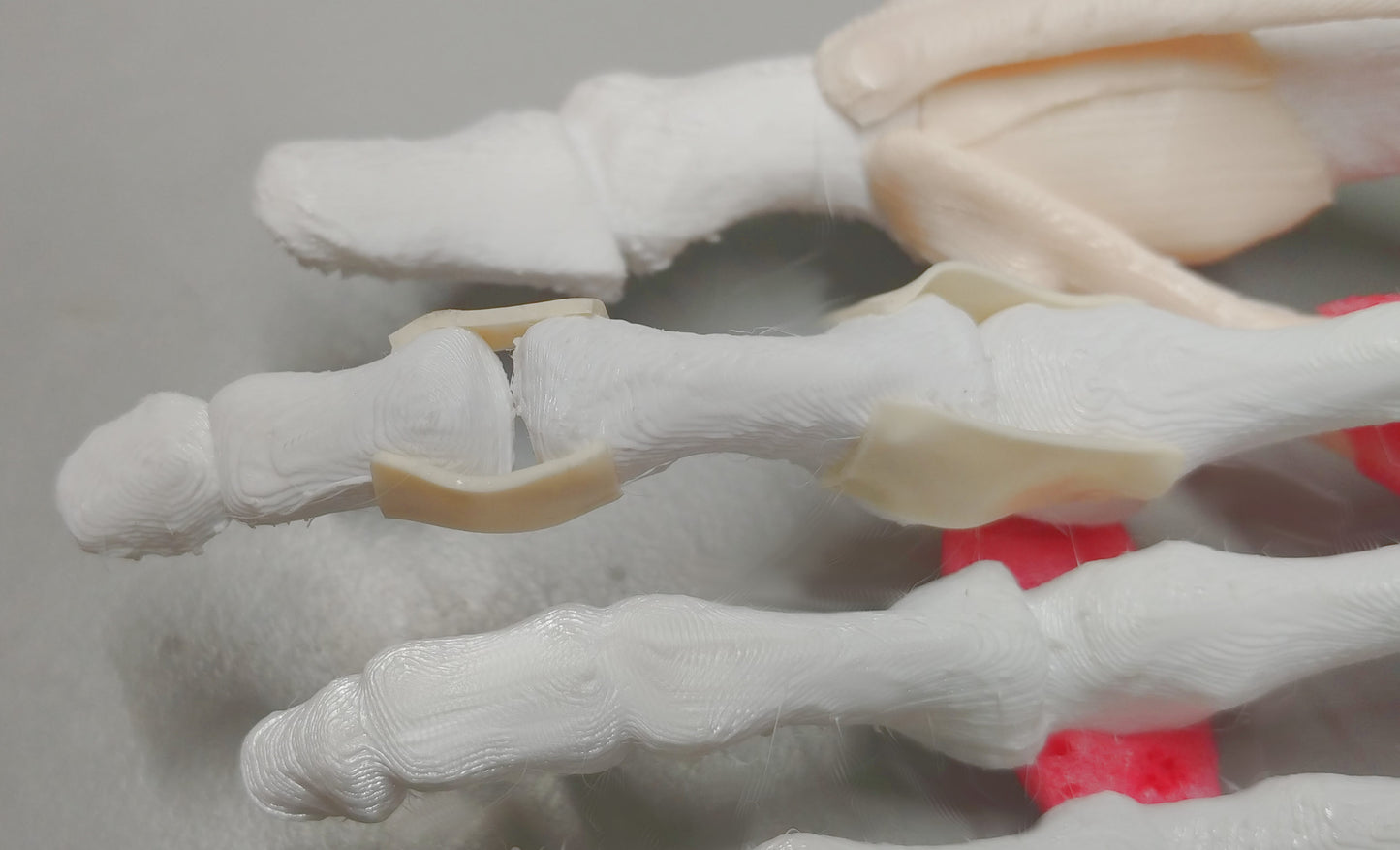 Comprehensive Bunion Foot – Uncast