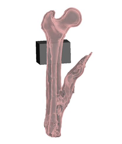 Mid Femur Amputee 1