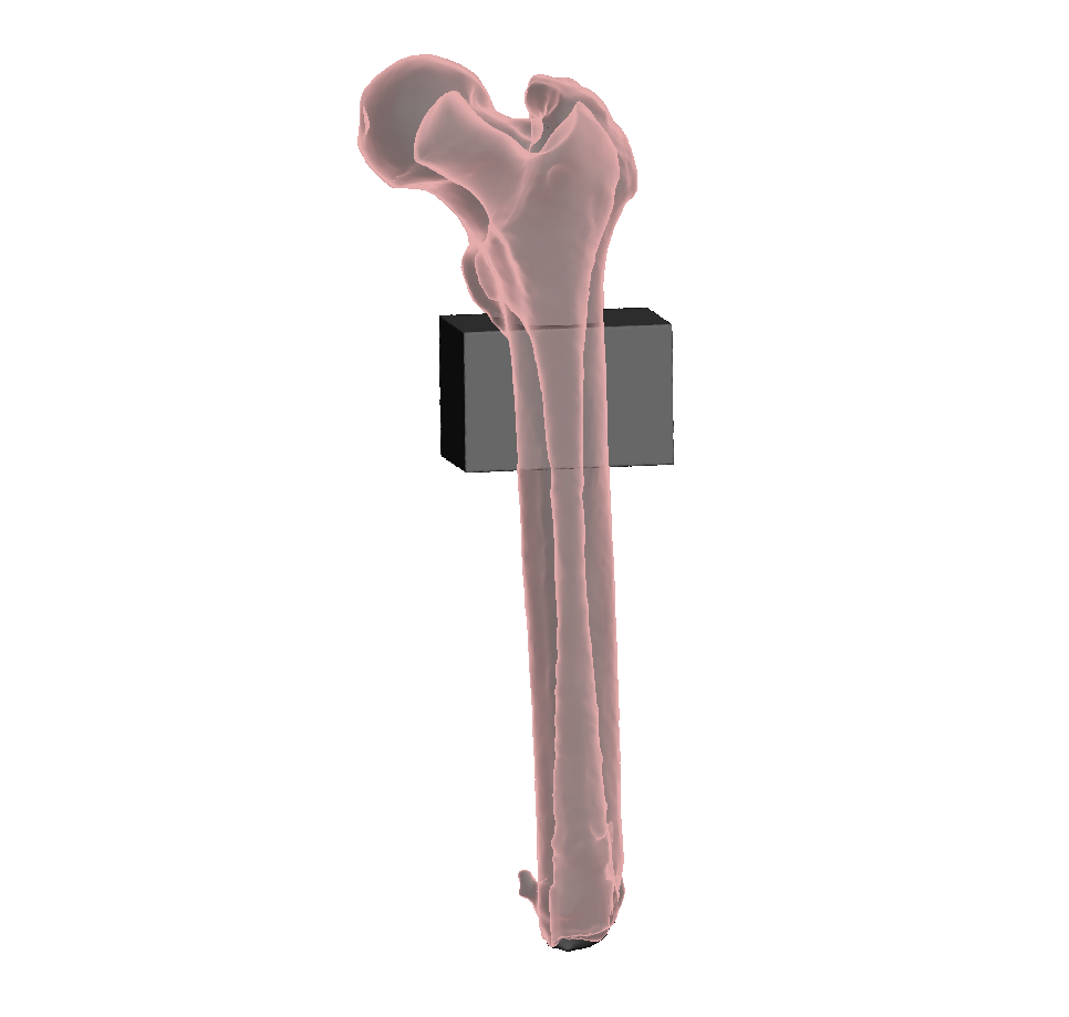 Mid Femur Amputee 3