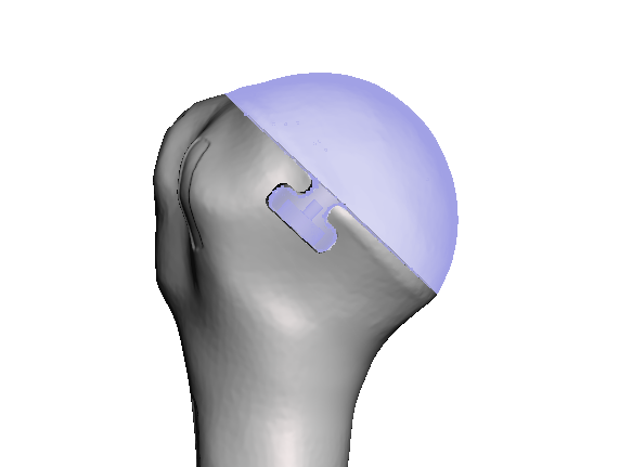 ROSA Normal Shoulder Registration Model with Removable Head and Coracoid