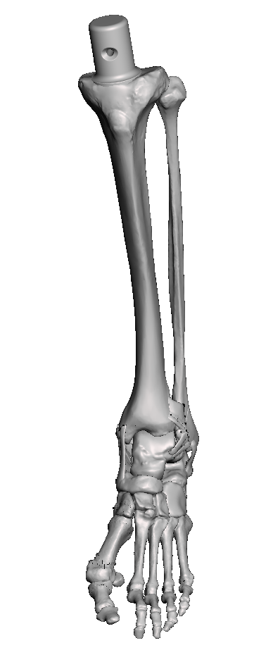 Weber B Fracture