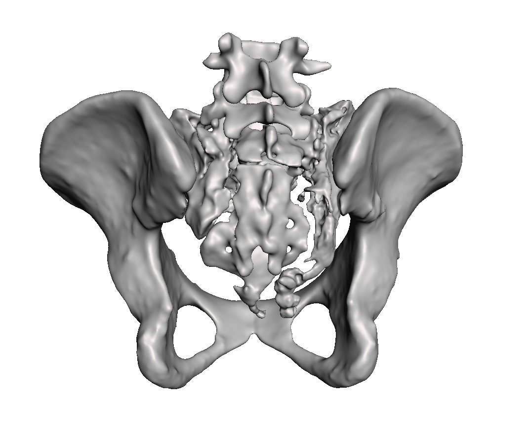 Sacral Fracture Bundle