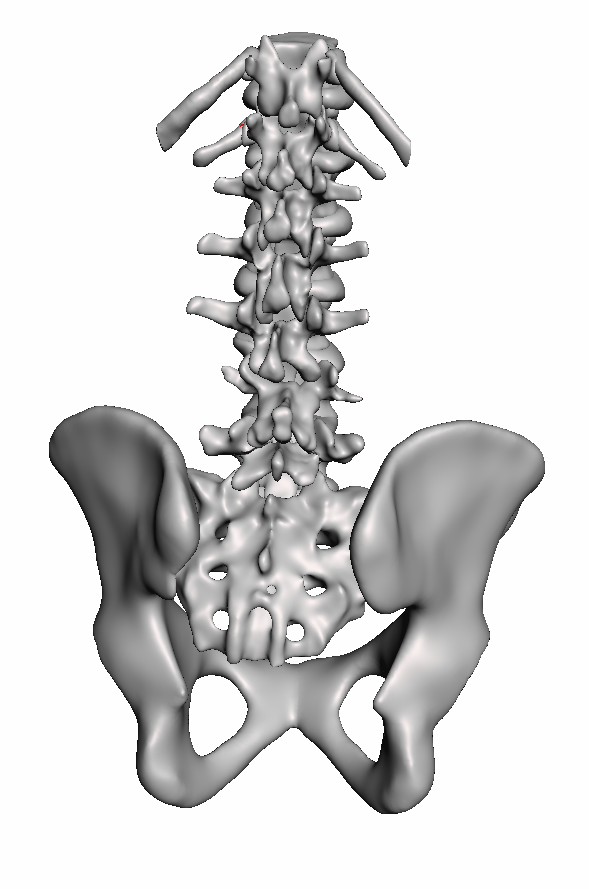 Spondylolisthesis 2