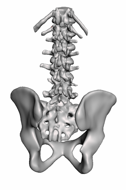 Spondylolisthesis 2