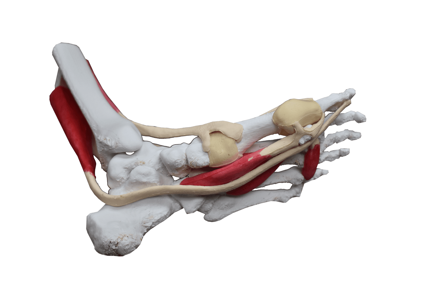 Comprehensive Bunion Foot – Cast