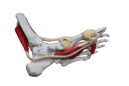 Comprehensive Bunion Foot – Cast