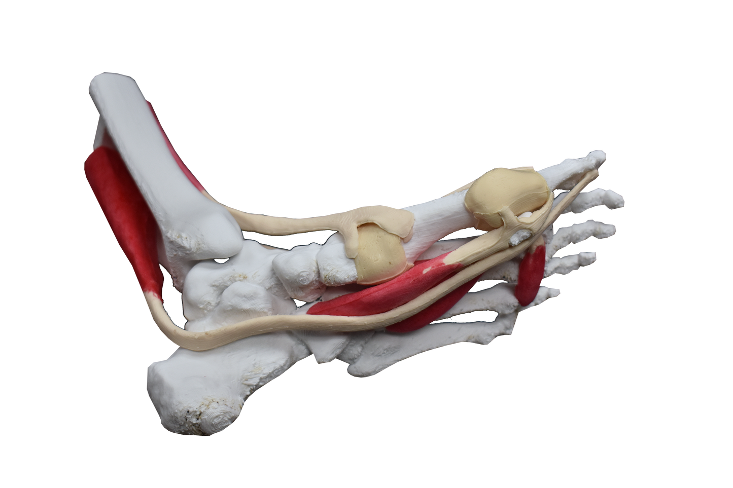 Comprehensive Bunion Foot – Uncast