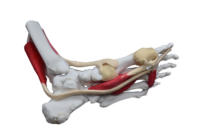 Comprehensive Bunion Foot – Uncast