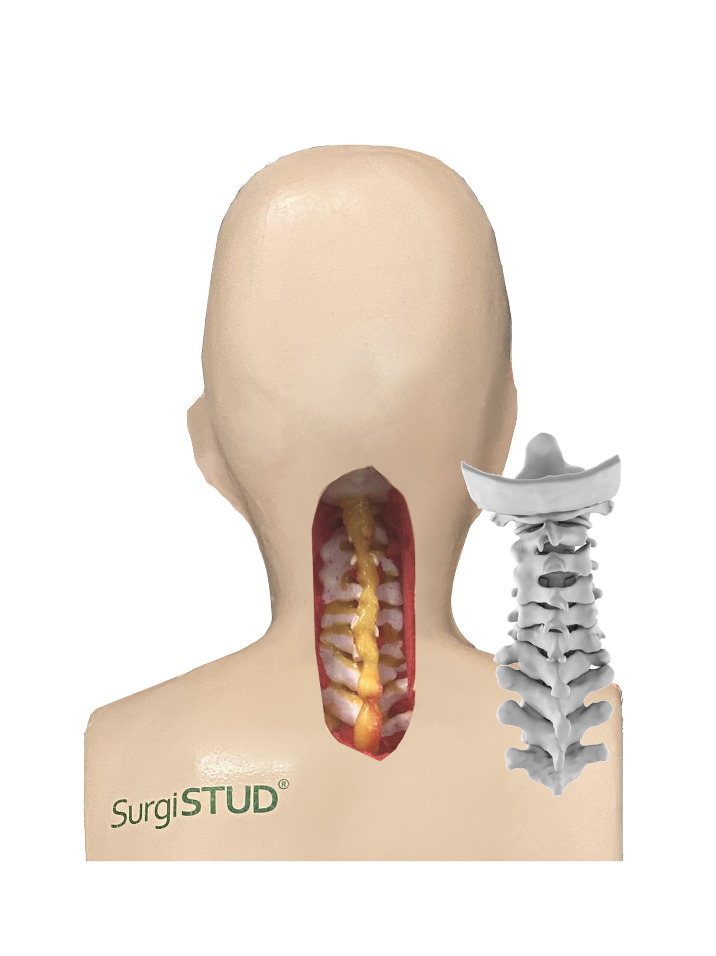 Chin-On-Chest Deformity 1