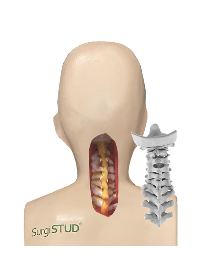 Chin-On-Chest Deformity 1
