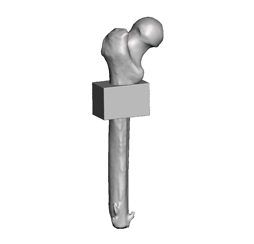 Mid Femur Amputee 3