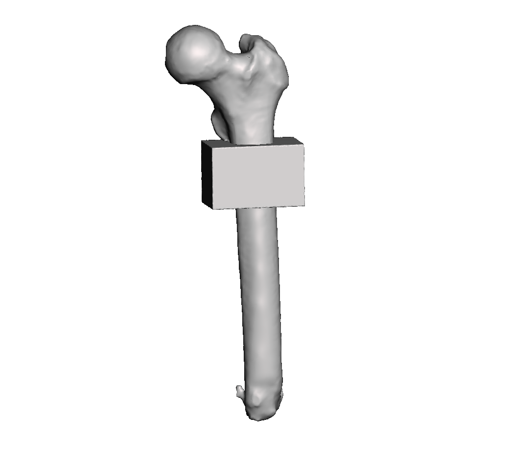 Mid Femur Amputee 3