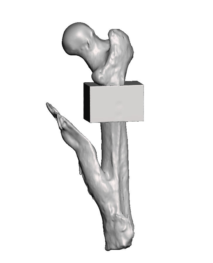 Mid Femur Amputee 1
