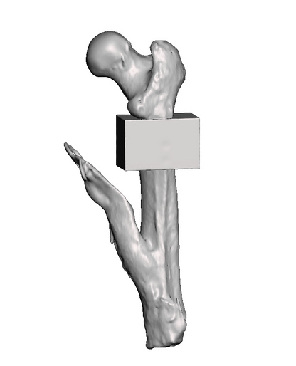 Mid Femur Amputee 1