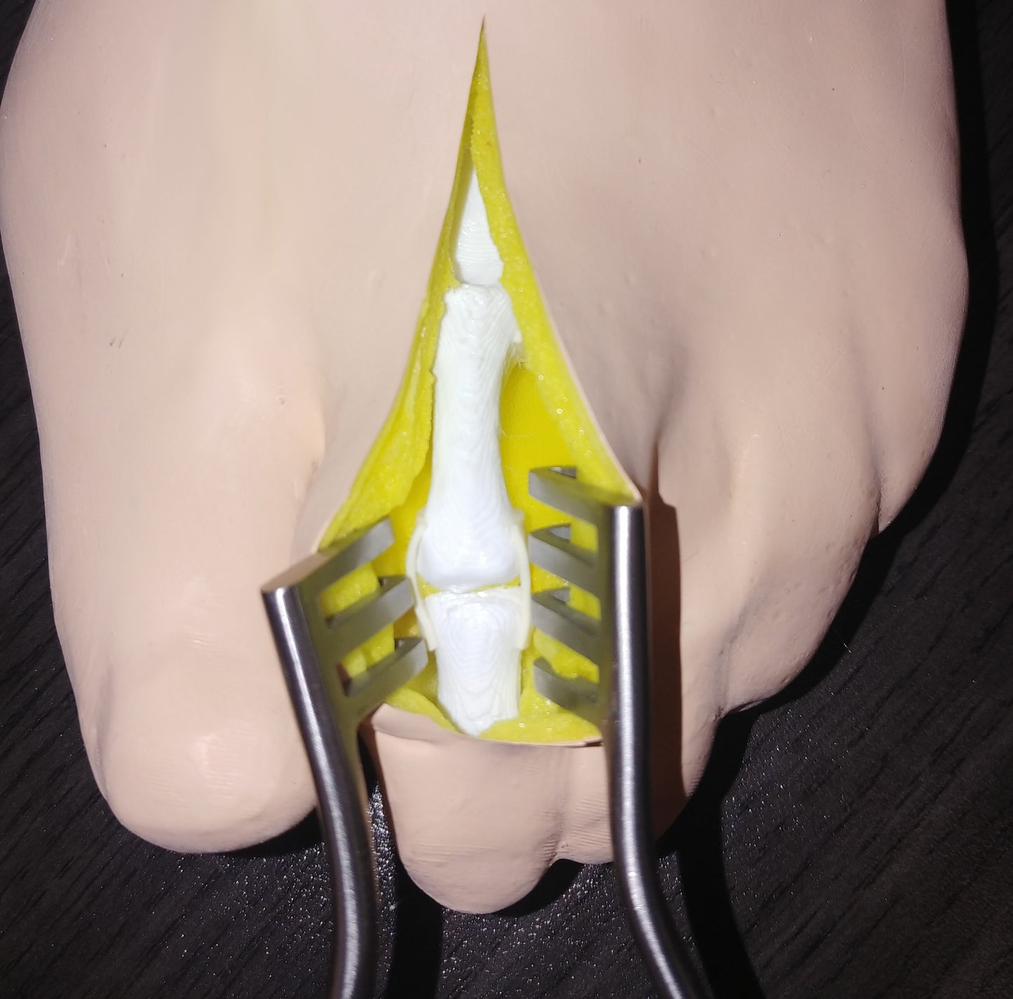 Comprehensive Bunion Foot – Cast