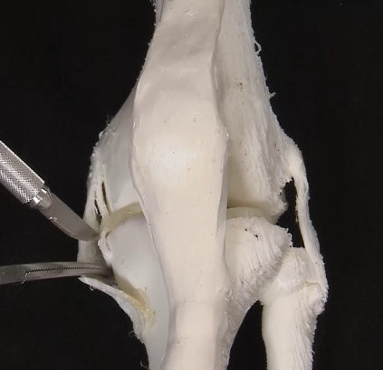 AMOA / 5 Degree Varus Knee