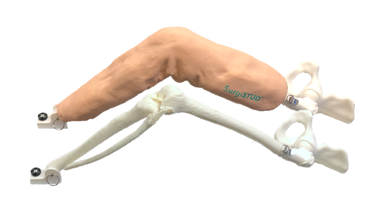 AMOA / 5 Degree Varus Knee