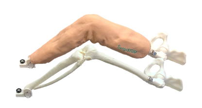 AMOA / 5 Degree Varus Knee