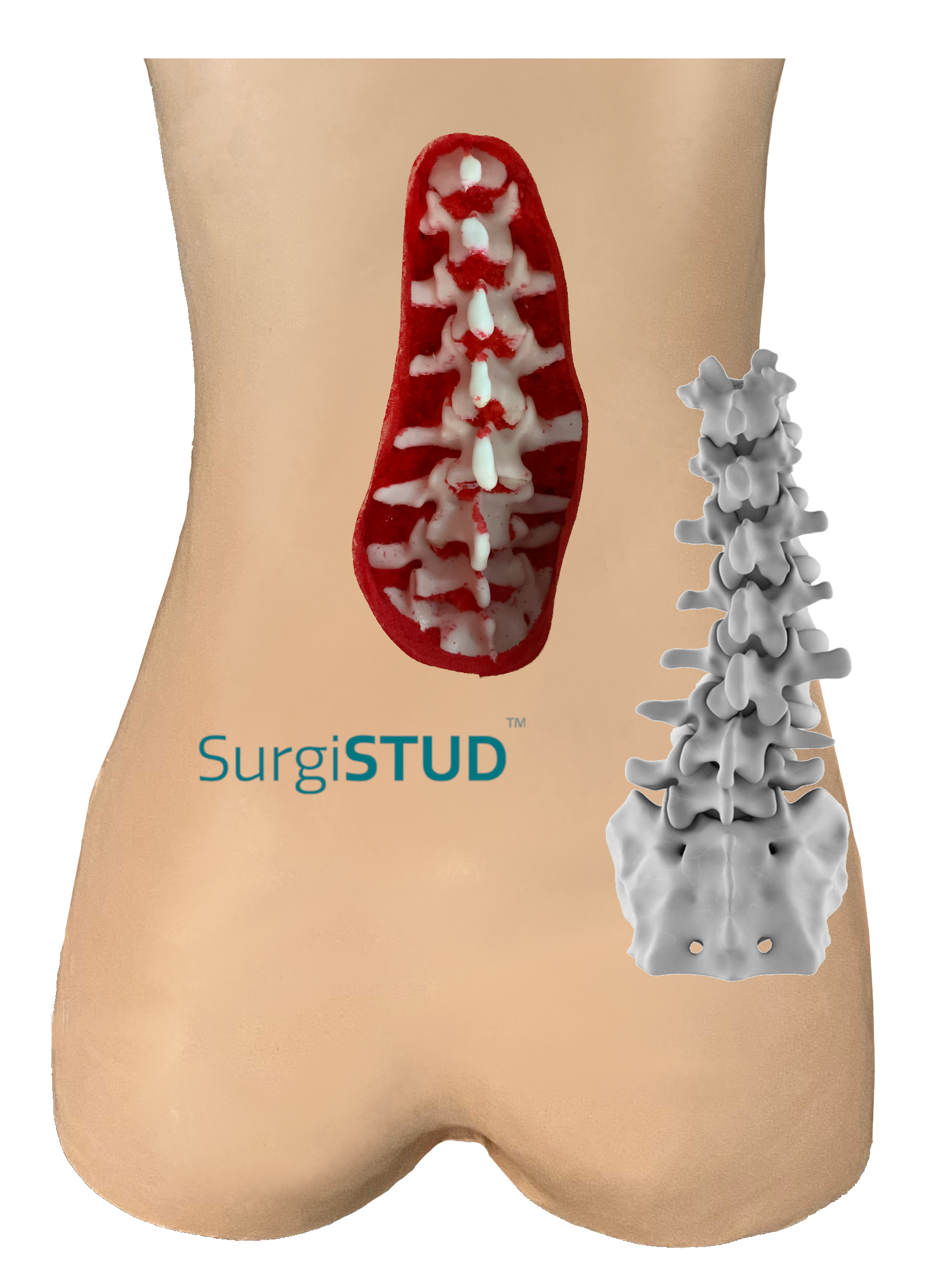 Lumbar Degenerative Scoliosis 1