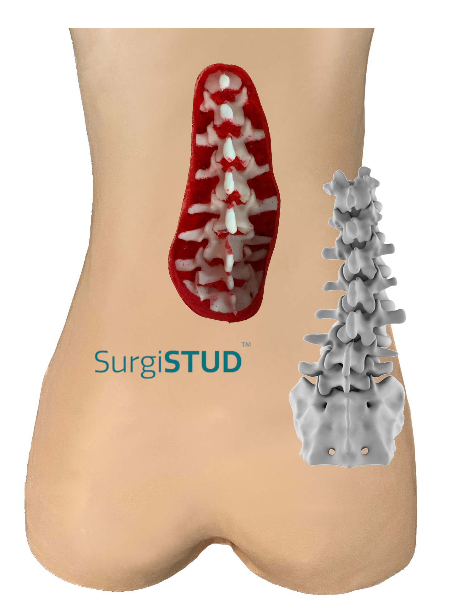 Lumbar Degenerative Scoliosis 1