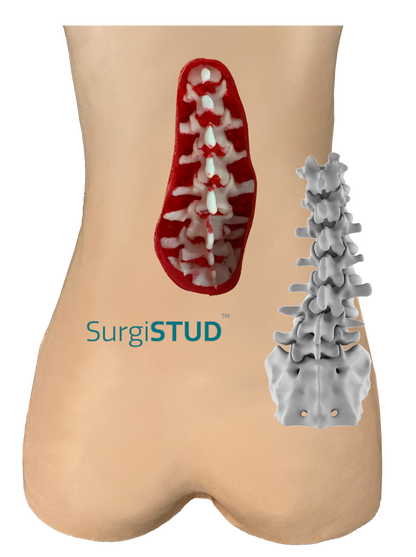 Lumbar Degenerative Scoliosis 1