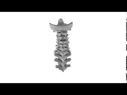 Chin-On-Chest Deformity 1