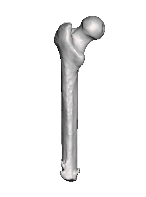 Mid Femur Amputee 3