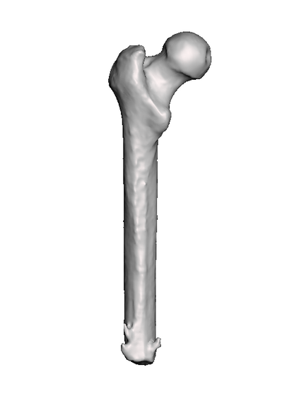 Mid Femur Amputee 3