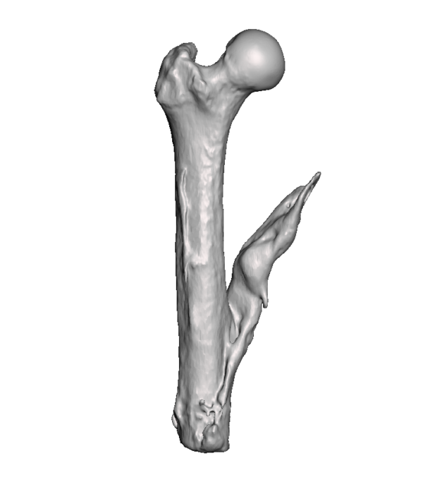 Mid Femur Amputee 1