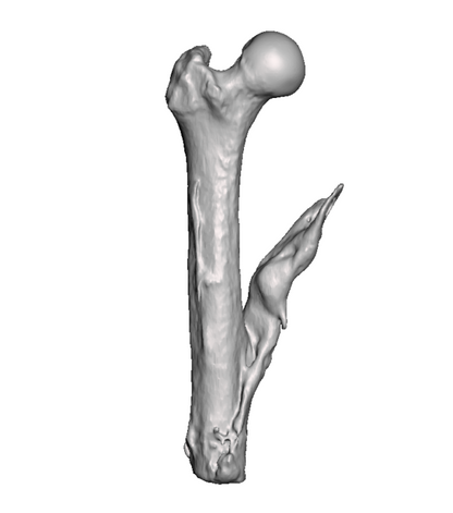 Mid Femur Amputee 1