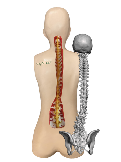 Occiput to Sacrum Trauma Spine