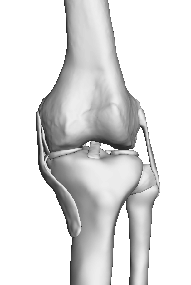 Varus Knee – 10 Degree Deformity