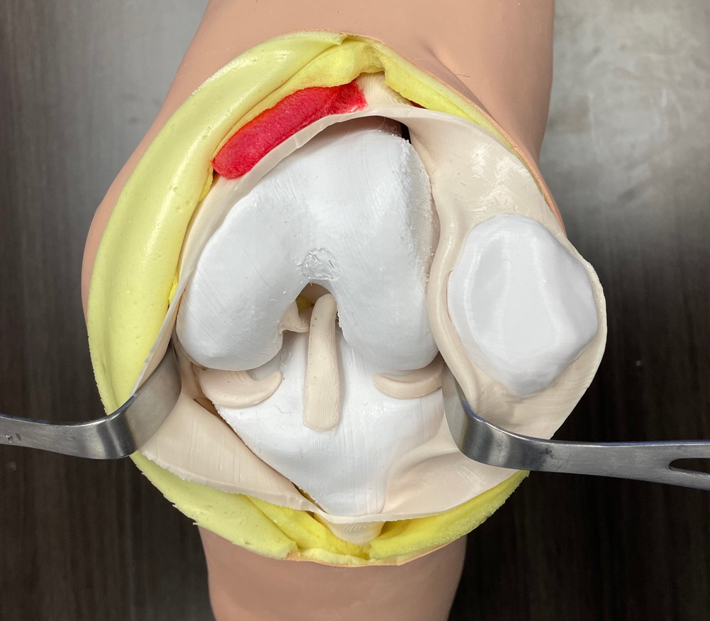 Zimmer PKA Knee - Casted